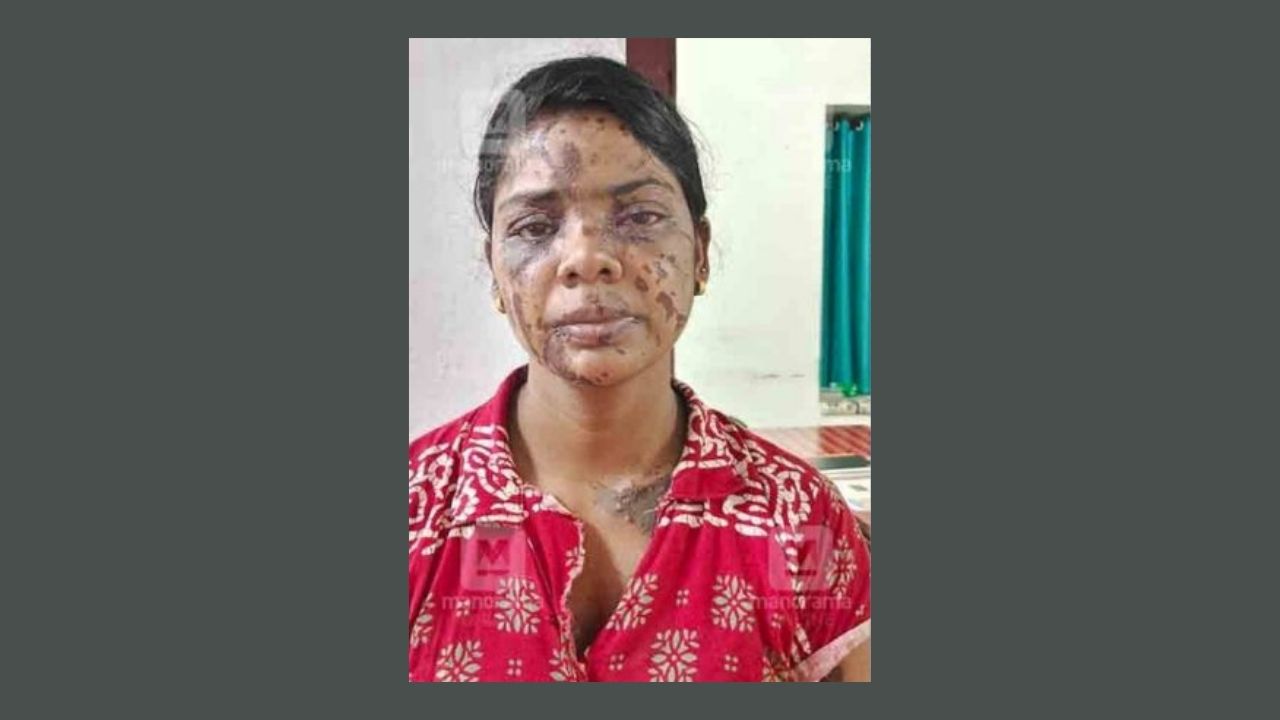 Girlfriend Throws Acid On Boyfriend Because He Decided To Marry Someone Else
